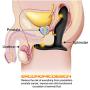 Male Prostata Massager Silent Vibranting Massage Men Health Dual Ring - Black